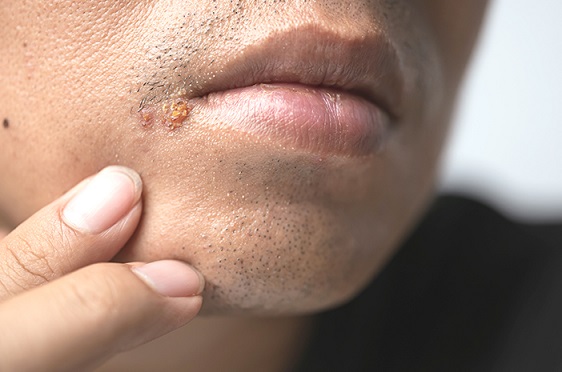Living with Herpes: Coping Strategies and Support